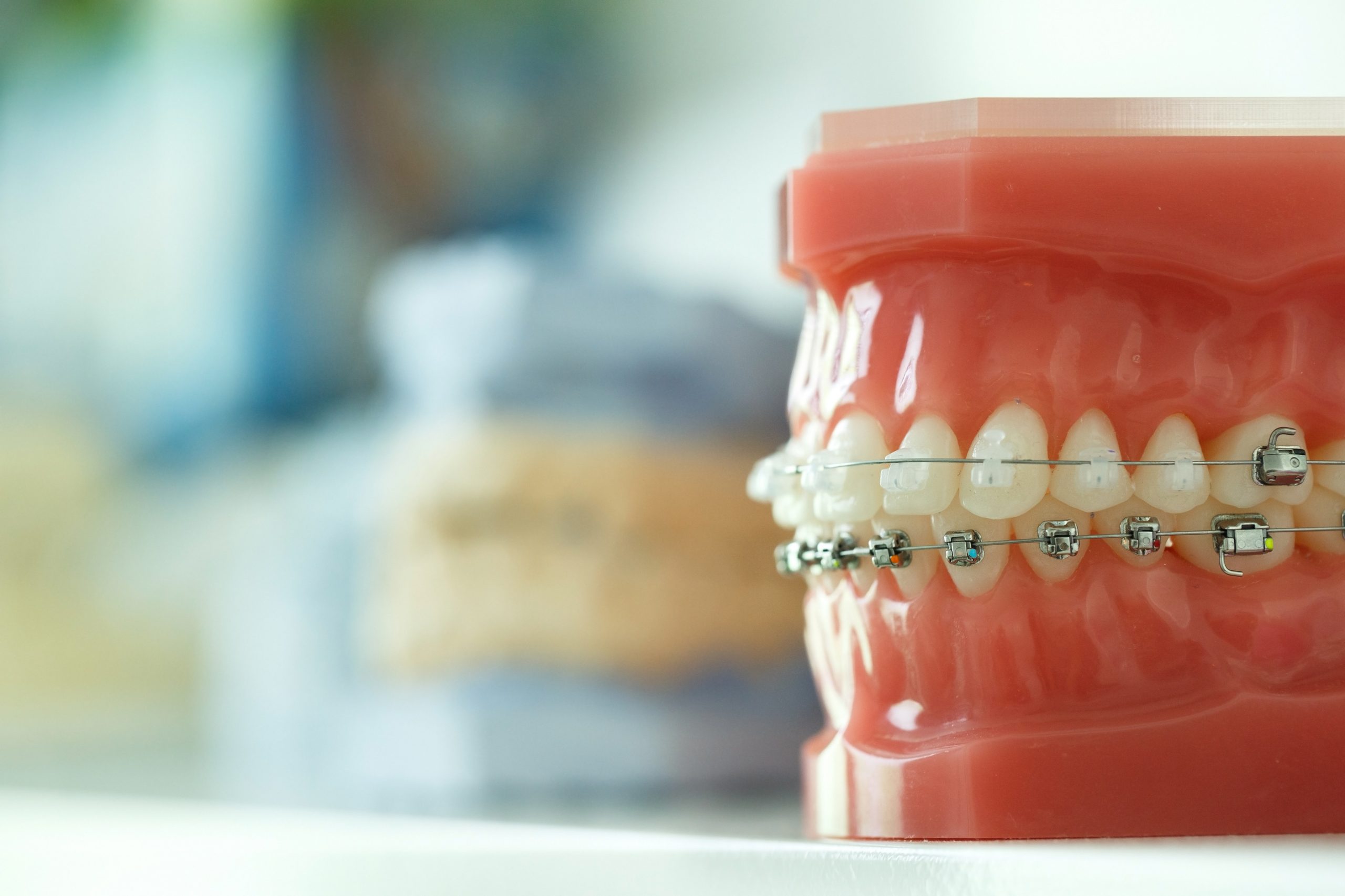 What Foods Break Braces Most Often—and How to Avoid Emergencies